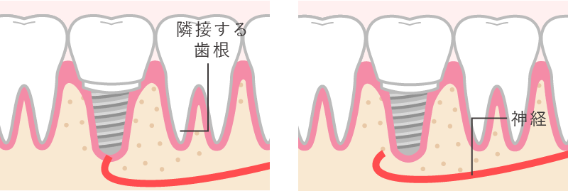 ガイド埋入位置