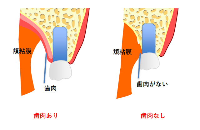 付着歯肉が少ない場合