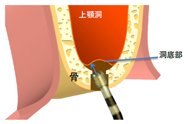 ソケットリフト
