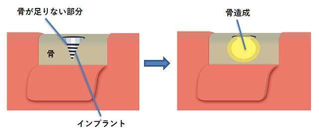 GBR骨造成