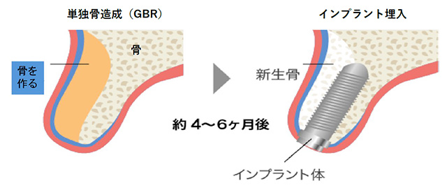GBR単独オペ