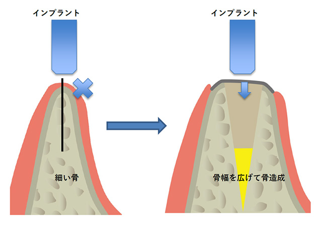 リッジエキスパンジョン