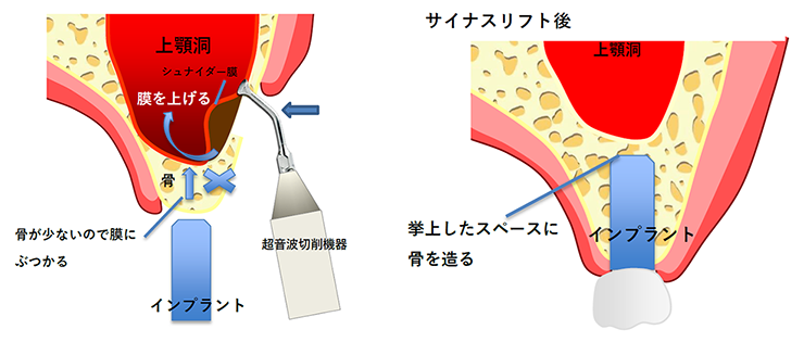 サイナスリフト