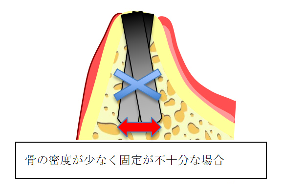 オッセオデンシフィケーション