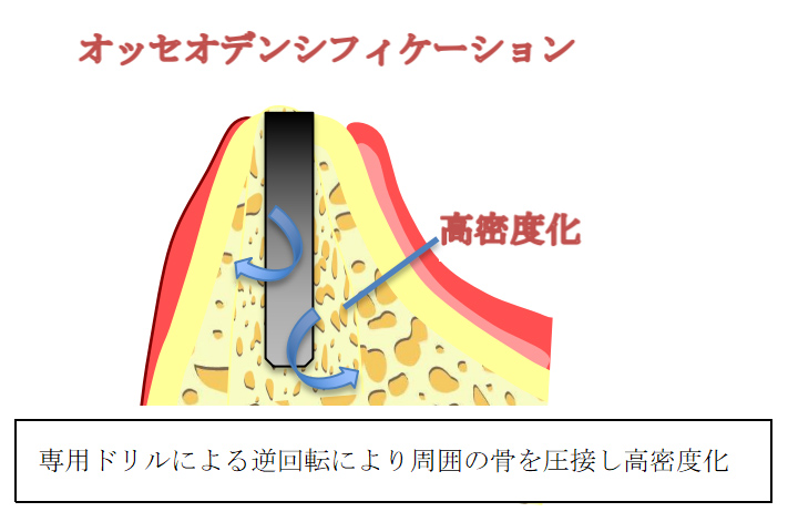 オッセオデンシフィケーション