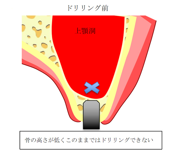 サイナスオートグラフト