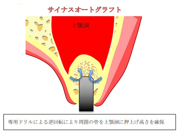 サイナスオートグラフト